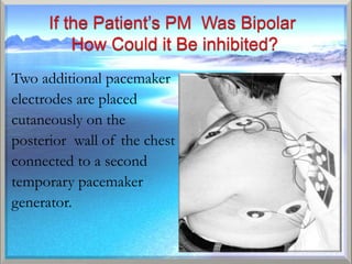 Two additional pacemaker
electrodes are placed
cutaneously on the
posterior wall of the chest and
connected to a second
temporary pacemaker
generator.
 