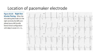 Location of pacemaker electrode
 