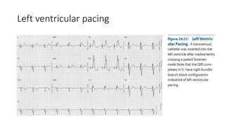 Left ventricular pacing
 