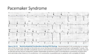 Pacemaker Syndrome
 
