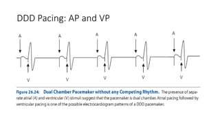 DDD Pacing: AP and VP
 