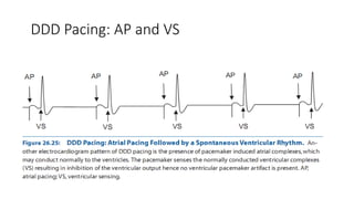 DDD Pacing: AP and VS
 