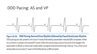 DDD Pacing: AS and VP
 