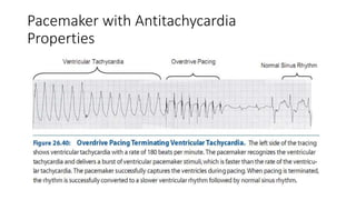 Pacemaker with Antitachycardia
Properties
 
