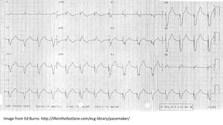 Pacemaker Histogram Pacemaker Rhythms | PDF