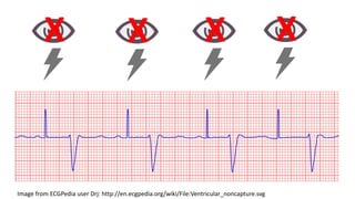 Undersensing Pacemaker Rythm Pacemaker Rhythms | PDF