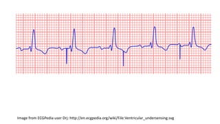 Undersensing Pacemaker Rythm Pacemaker Rhythms | PDF