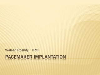 PACEMAKER IMPLANTATION
Waleed Roshdy , TRG
 