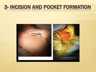 3- INCISION AND POCKET FORMATION
 