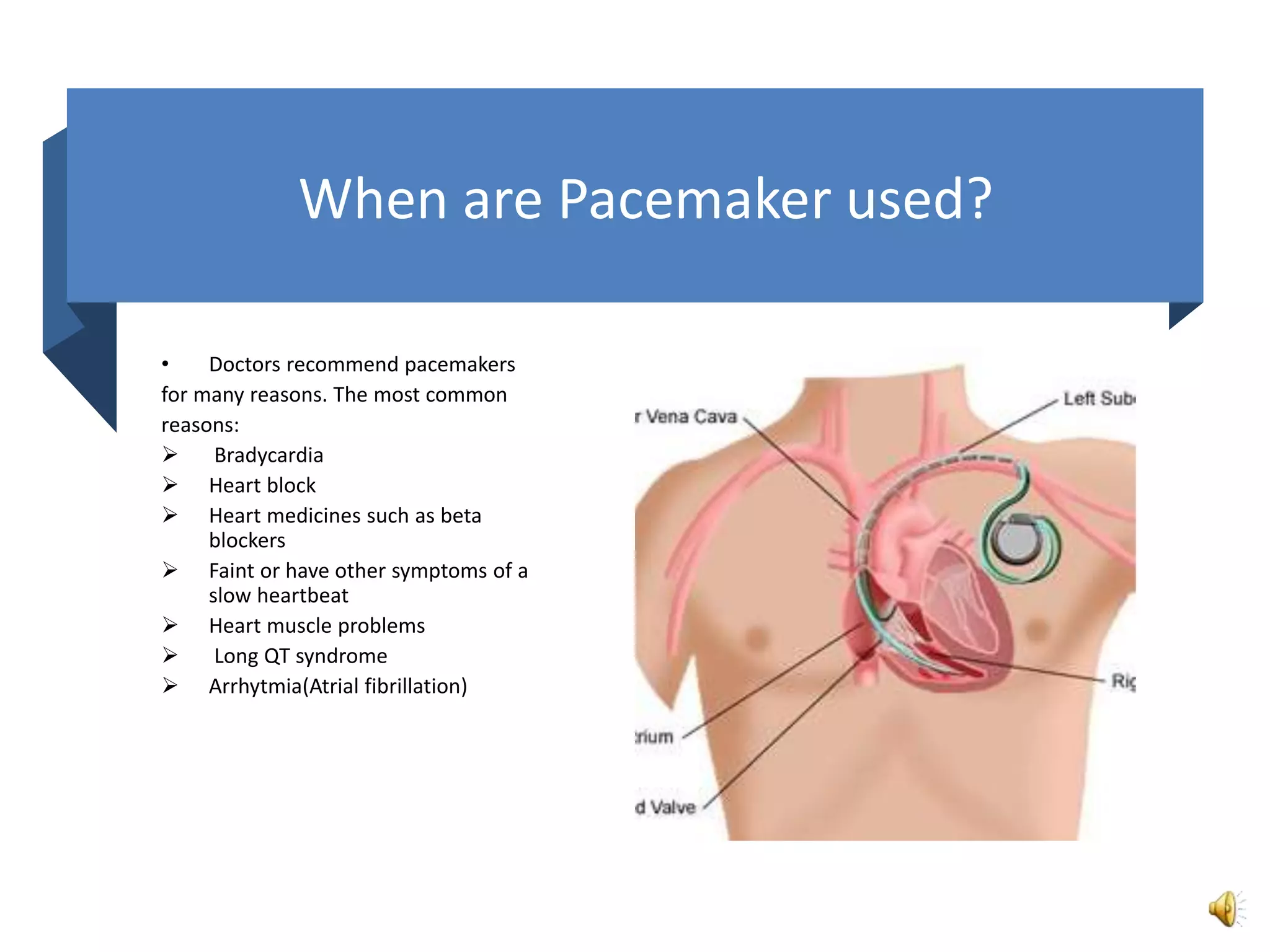 Pacer. Use Pacemaker | PPTX