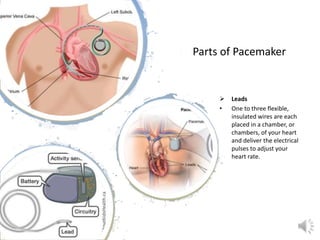 Parts of Pacemaker
 Leads
• One to three flexible,
insulated wires are each
placed in a chamber, or
chambers, of your heart
and deliver the electrical
pulses to adjust your
heart rate.
 