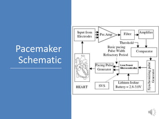 Pacemaker
Schematic
 