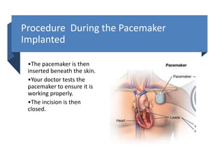 Pacemaker | PPTX