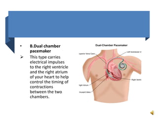 • B.Dual chamber
pacemaker
 This type carries
electrical impulses
to the right ventricle
and the right atrium
of your heart to help
control the timing of
contractions
between the two
chambers.
 
