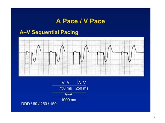 Evaluation and management of Pacemaker malfunction | PPTX | Heart and ...