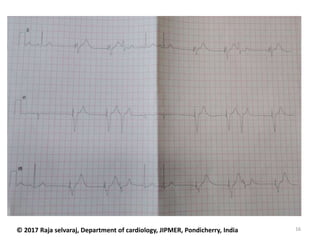 16© 2017 Raja selvaraj, Department of cardiology, JIPMER, Pondicherry, India
 