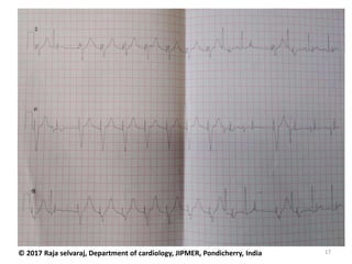 17© 2017 Raja selvaraj, Department of cardiology, JIPMER, Pondicherry, India
 