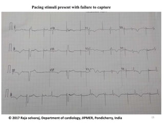 19
Pacing stimuli present with failure to capture
© 2017 Raja selvaraj, Department of cardiology, JIPMER, Pondicherry, India
 