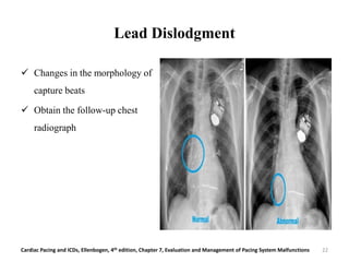 Lead Dislodgment
 Changes in the morphology of
capture beats
 Obtain the follow-up chest
radiograph
Cardiac Pacing and ICDs, Ellenbogen, 4th edition, Chapter 7, Evaluation and Management of Pacing System Malfunctions 22
 