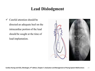 Lead Dislodgment
 Careful attention should be
directed an adequate heel on the
intracardiac portion of the lead
should be sought at the time of
lead implantation.
Cardiac Pacing and ICDs, Ellenbogen, 4th edition, Chapter 7, Evaluation and Management of Pacing System Malfunctions 24
 