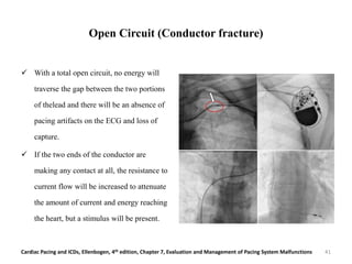 Open Circuit (Conductor fracture)
 With a total open circuit, no energy will
traverse the gap between the two portions
of thelead and there will be an absence of
pacing artifacts on the ECG and loss of
capture.
 If the two ends of the conductor are
making any contact at all, the resistance to
current flow will be increased to attenuate
the amount of current and energy reaching
the heart, but a stimulus will be present.
Cardiac Pacing and ICDs, Ellenbogen, 4th edition, Chapter 7, Evaluation and Management of Pacing System Malfunctions 41
 