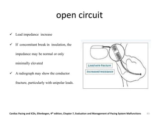 open circuit
 Lead impedance increase
 If concomitant break in insulation, the
impedance may be normal or only
minimally elevated
 A radiograph may show the conductor
fracture, particularly with unipolar leads.
Cardiac Pacing and ICDs, Ellenbogen, 4th edition, Chapter 7, Evaluation and Management of Pacing System Malfunctions 43
 