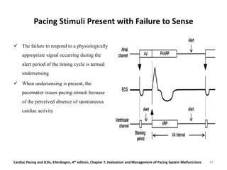 Pacing Stimuli Present with Failure to Sense
 The failure to respond to a physiologically
appropriate signal occurring during the
alert period of the timing cycle is termed
undersensing
 When undersensing is present, the
pacemaker issues pacing stimuli because
of the perceived absence of spontaneous
cardiac activity
47Cardiac Pacing and ICDs, Ellenbogen, 4th edition, Chapter 7, Evaluation and Management of Pacing System Malfunctions
 