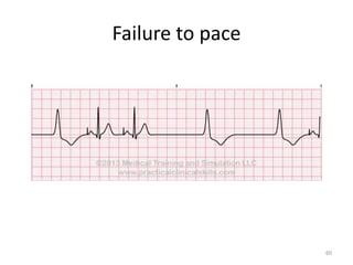 Failure to pace
60
 