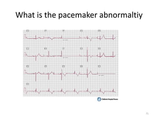 What is the pacemaker abnormaltiy
71
 