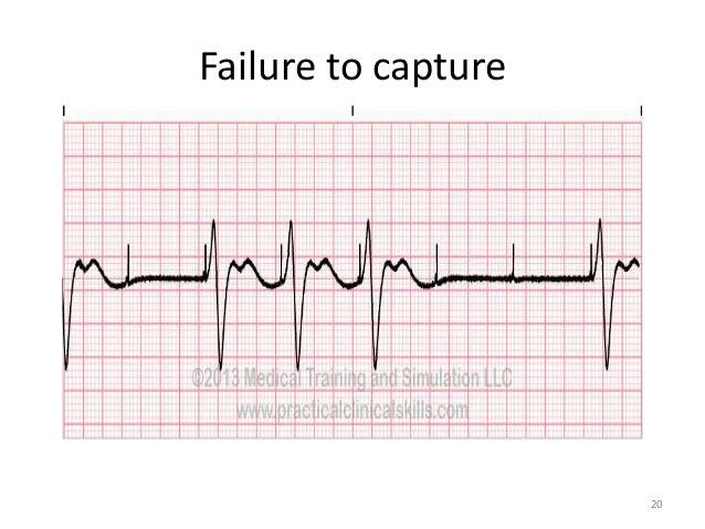 failure to capture pacemaker