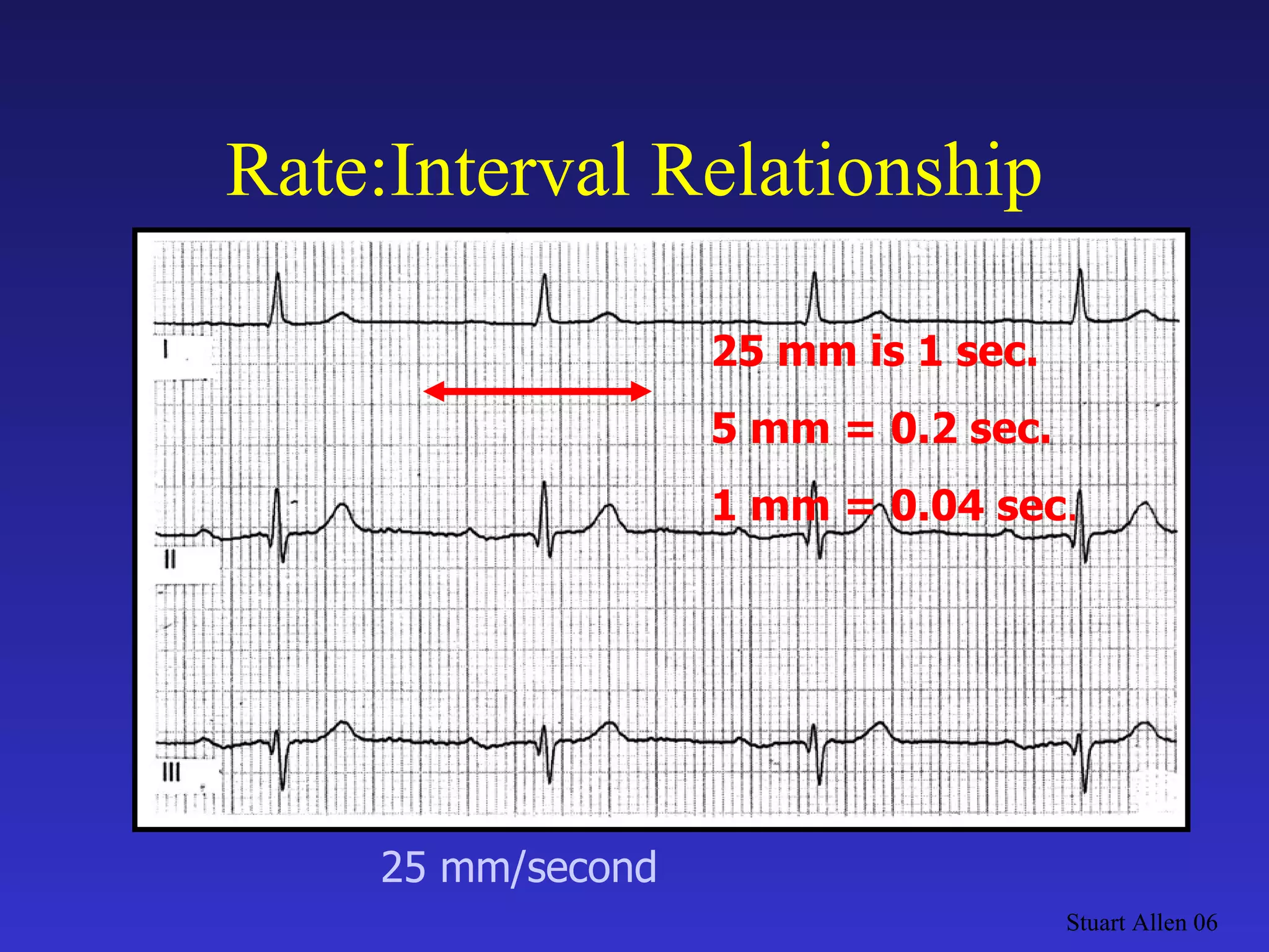 Stuart Allen 06 Rate:Interval Relationship 25 mm is 1 sec. 5 mm = 0.2 sec. 1 mm = 0.04 sec . 25 mm/second 