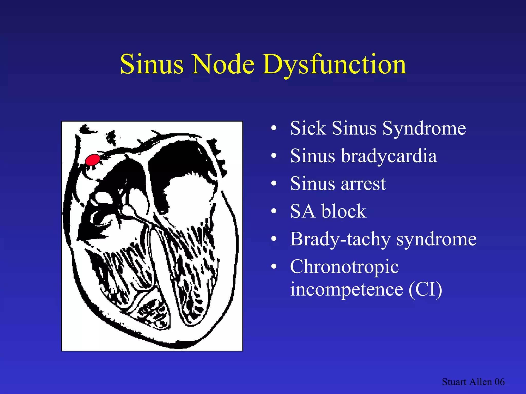 Sinus Node Dysfunction Sick Sinus Syndrome Sinus bradycardia Sinus arrest SA block Brady-tachy syndrome Chronotropic incompetence (CI) Stuart Allen 06 