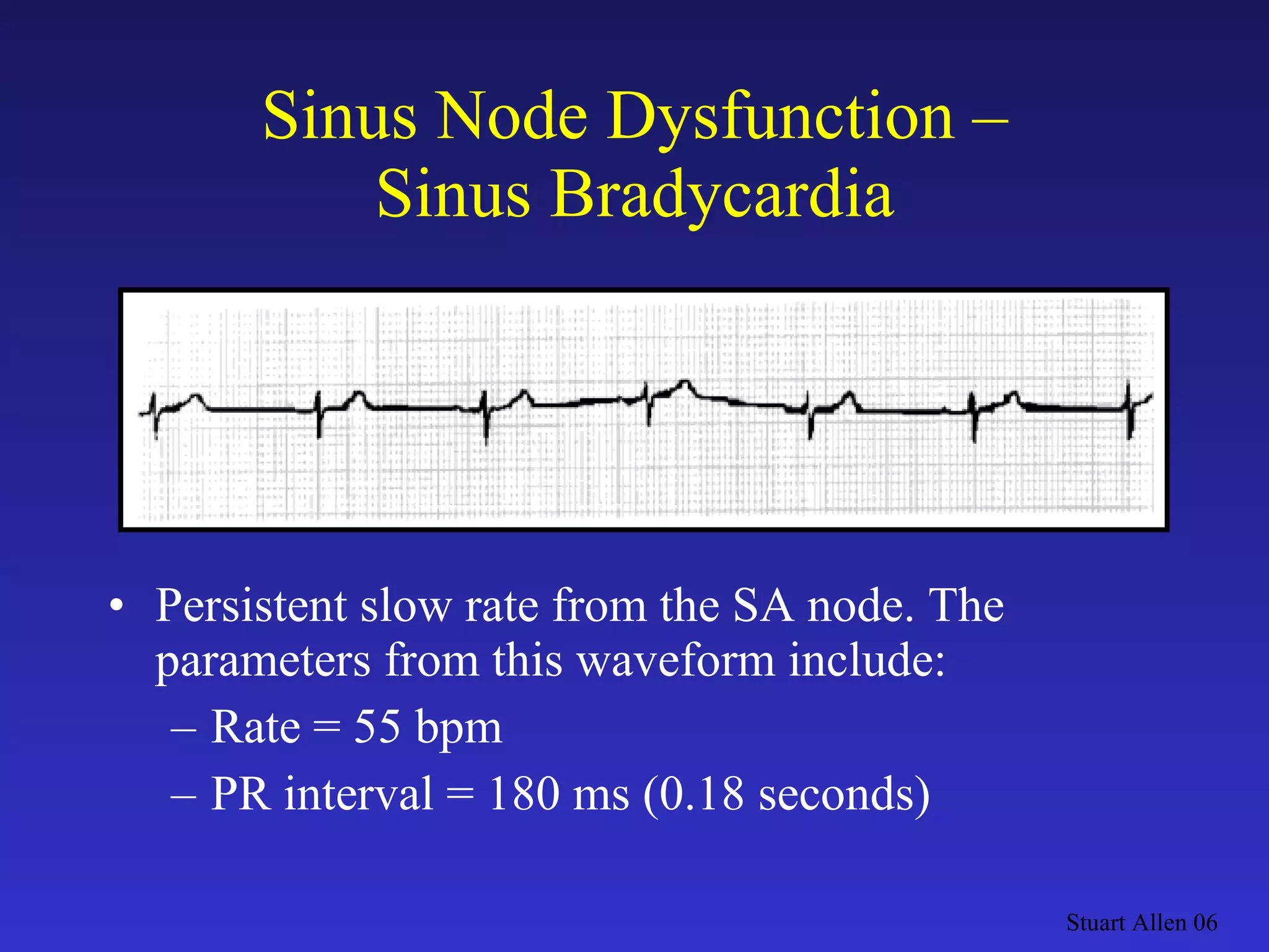 Sinus Node Dysfunction – Sinus Bradycardia Persistent slow rate from the SA node. The parameters from this waveform include: Rate = 55 bpm PR interval = 180 ms (0.18 seconds) Stuart Allen 06 