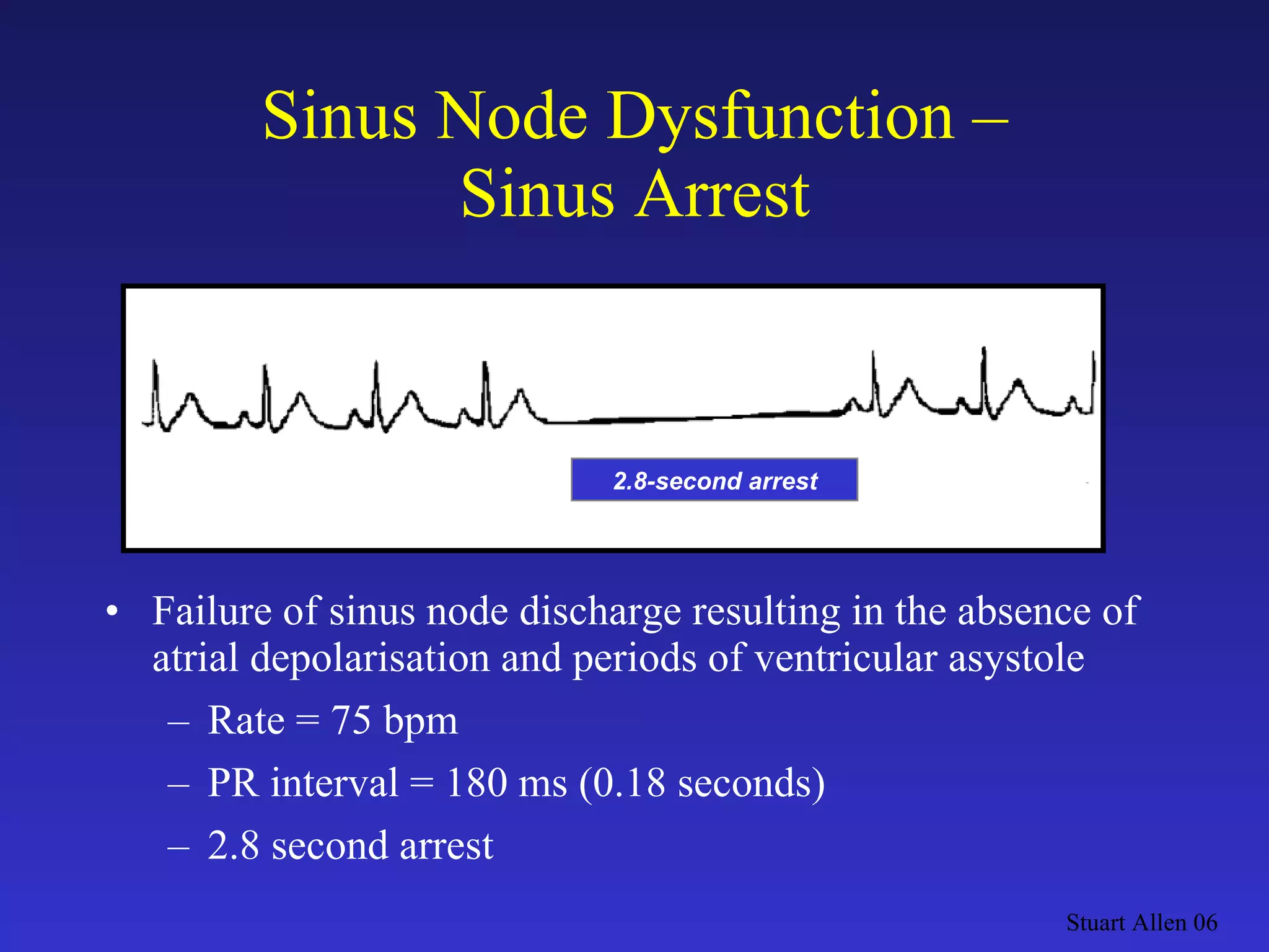 Sinus Node Dysfunction – Sinus Arrest Failure of sinus node discharge resulting in the absence of atrial depolarisation and periods of ventricular asystole Rate = 75 bpm PR interval = 180 ms (0.18 seconds) 2.8 second arrest Stuart Allen 06 2.8-second arrest 