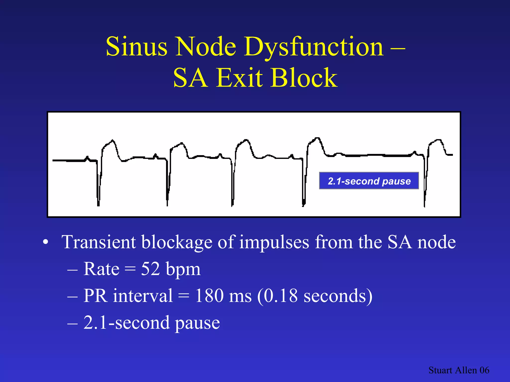 Sinus Node Dysfunction – SA Exit Block Transient blockage of impulses from the SA node Rate = 52 bpm PR interval = 180 ms (0.18 seconds) 2.1-second pause Stuart Allen 06 2.1-second pause 