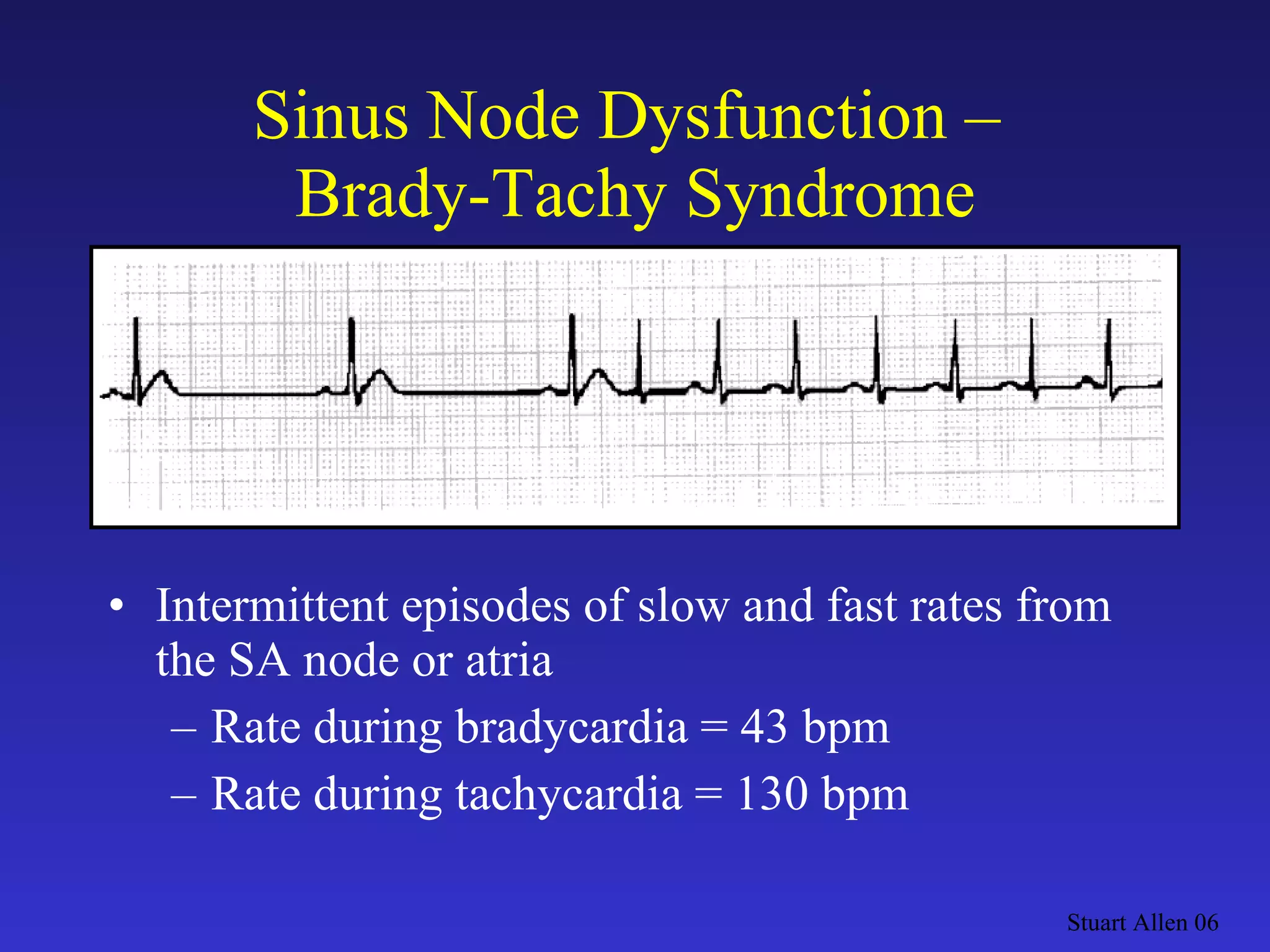 Sinus Node Dysfunction –  Brady-Tachy Syndrome Intermittent episodes of slow and fast rates from the SA node or atria Rate during bradycardia = 43 bpm Rate during tachycardia = 130 bpm Stuart Allen 06 