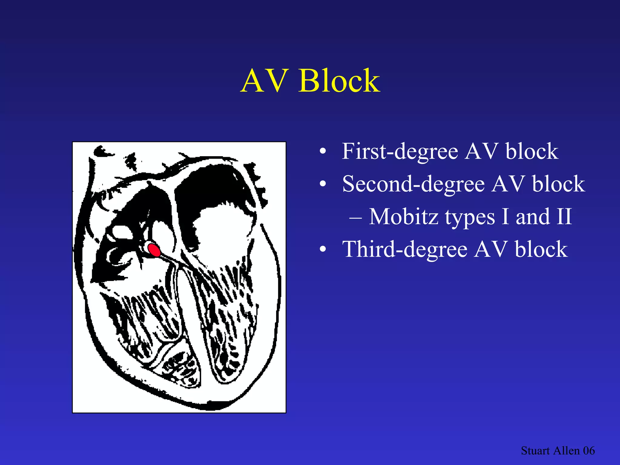 AV Block First-degree AV block Second-degree AV block Mobitz types I and II Third-degree AV block Stuart Allen 06 