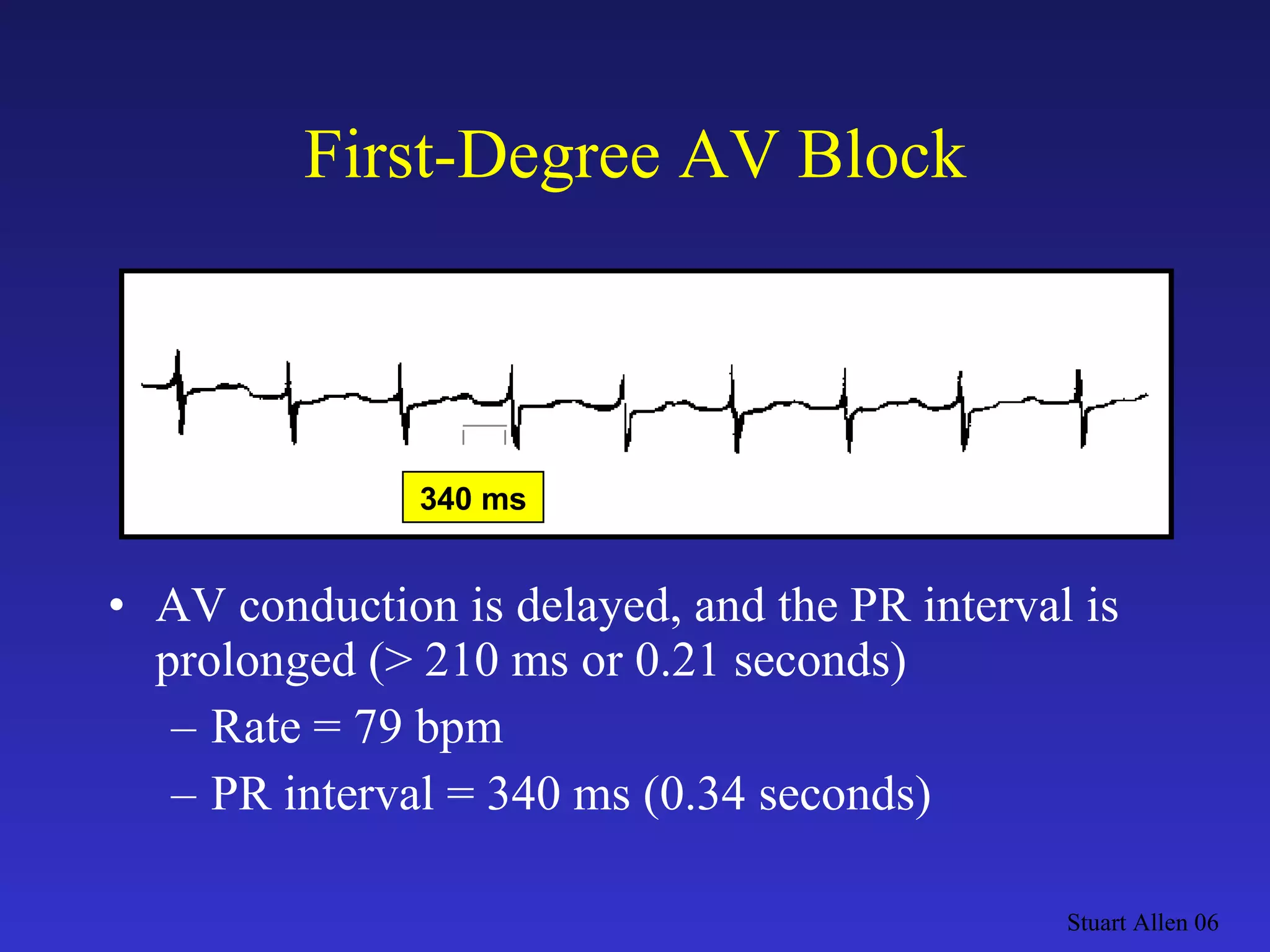 First-Degree AV Block AV conduction is delayed, and the PR interval is prolonged (> 210 ms or 0.21 seconds) Rate = 79 bpm PR interval = 340 ms (0.34 seconds) Stuart Allen 06 340 ms 