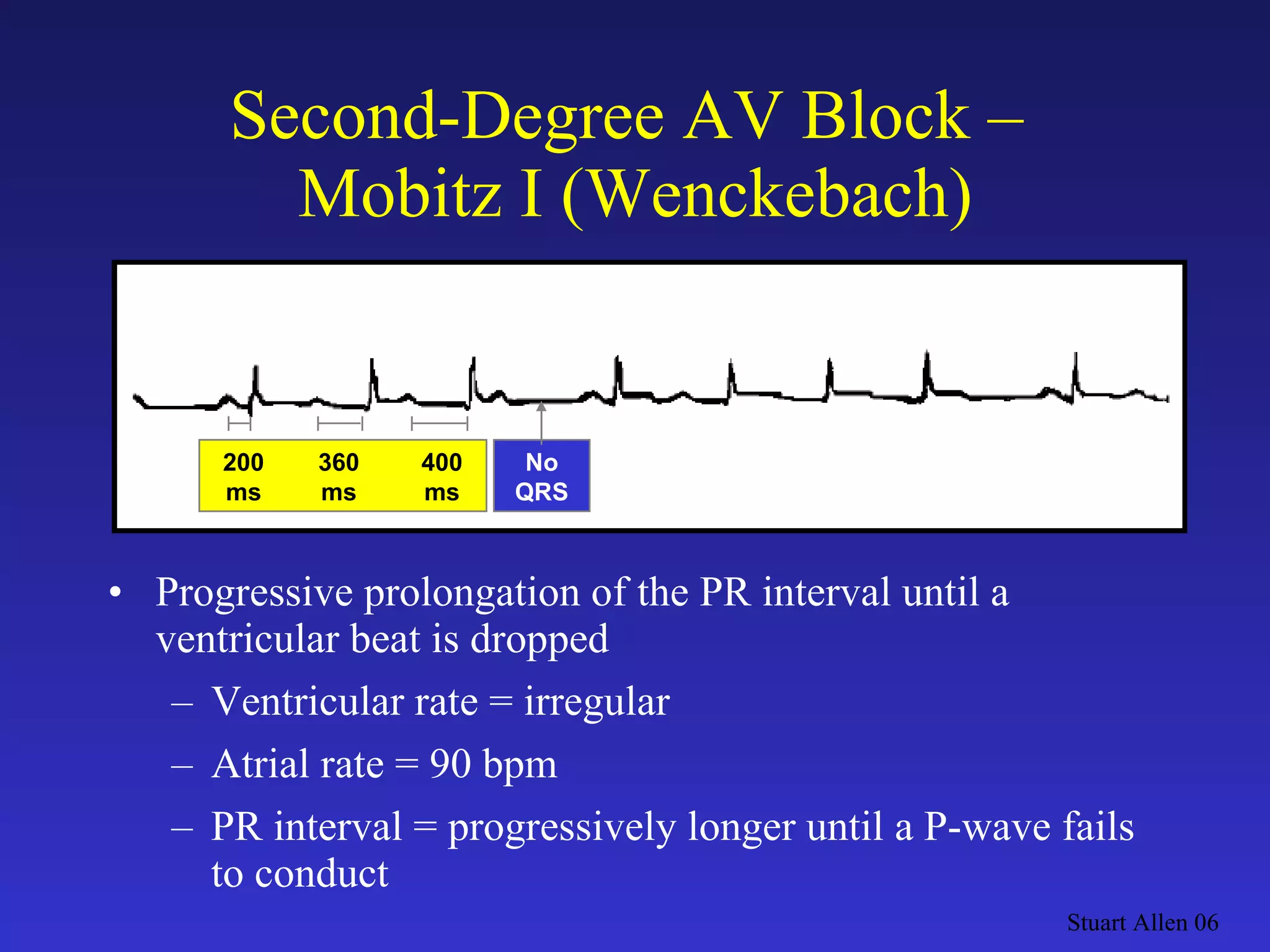 Second-Degree AV Block –  Mobitz I (Wenckebach) Progressive prolongation of the PR interval until a ventricular beat is dropped Ventricular rate = irregular Atrial rate = 90 bpm PR interval = progressively longer until a P-wave fails to conduct Stuart Allen 06 200 360 400 ms ms ms No QRS 