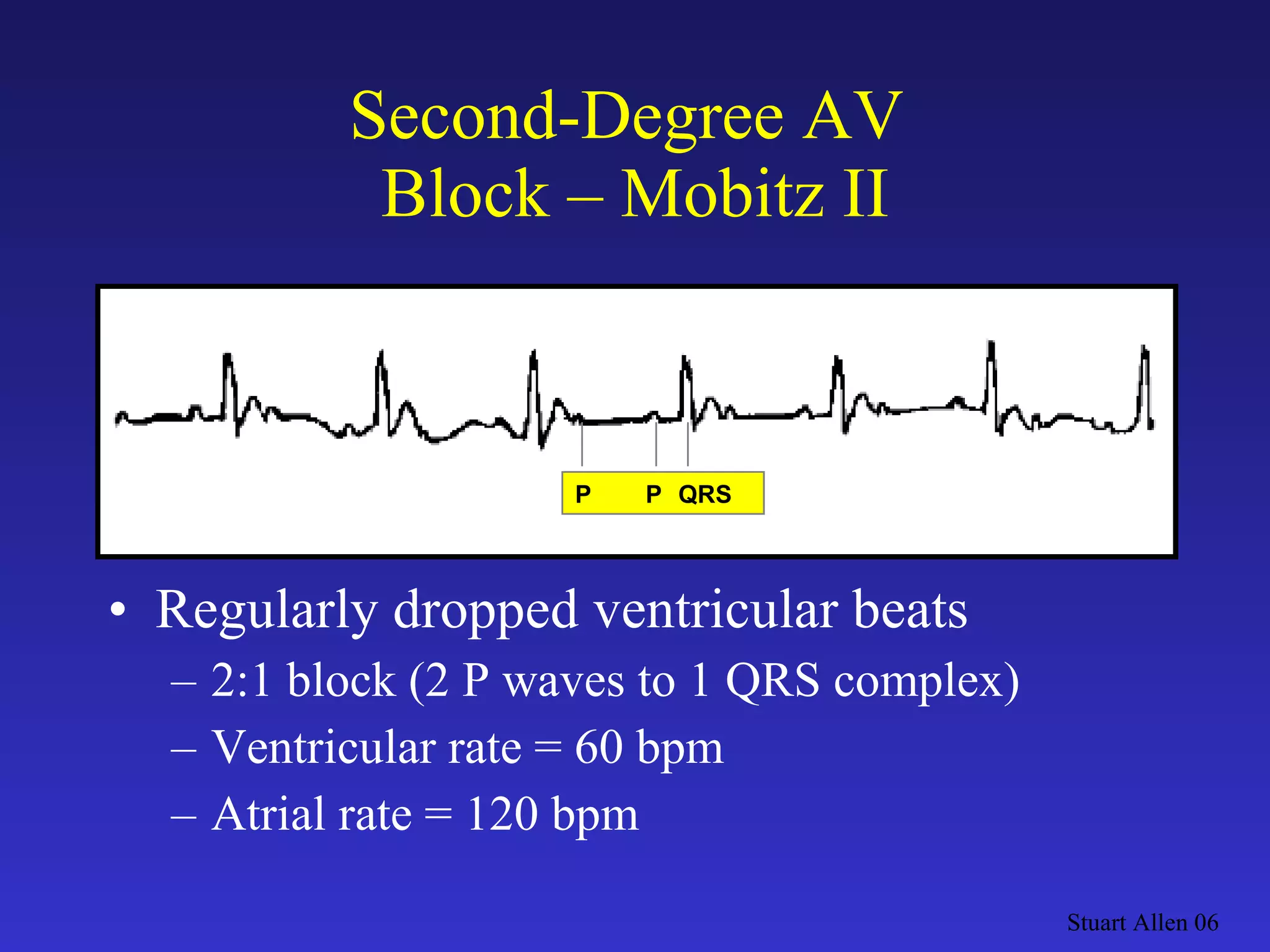 Second-Degree AV  Block – Mobitz II Regularly dropped ventricular beats 2:1 block (2 P waves to 1 QRS complex) Ventricular rate = 60 bpm Atrial rate = 120 bpm Stuart Allen 06 P  P QRS 