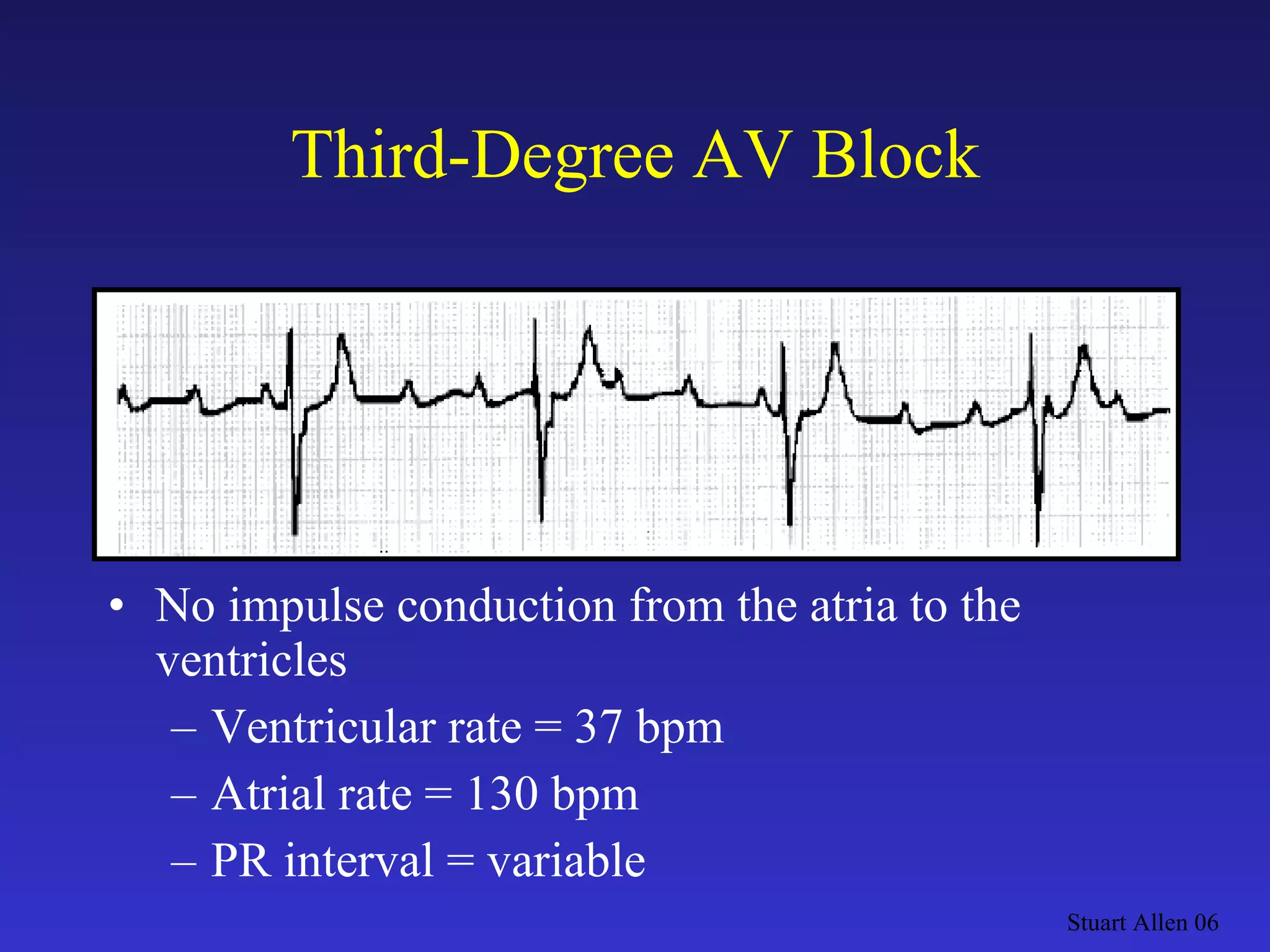 Third-Degree AV Block No impulse conduction from the atria to the ventricles Ventricular rate = 37 bpm Atrial rate = 130 bpm PR interval = variable Stuart Allen 06 
