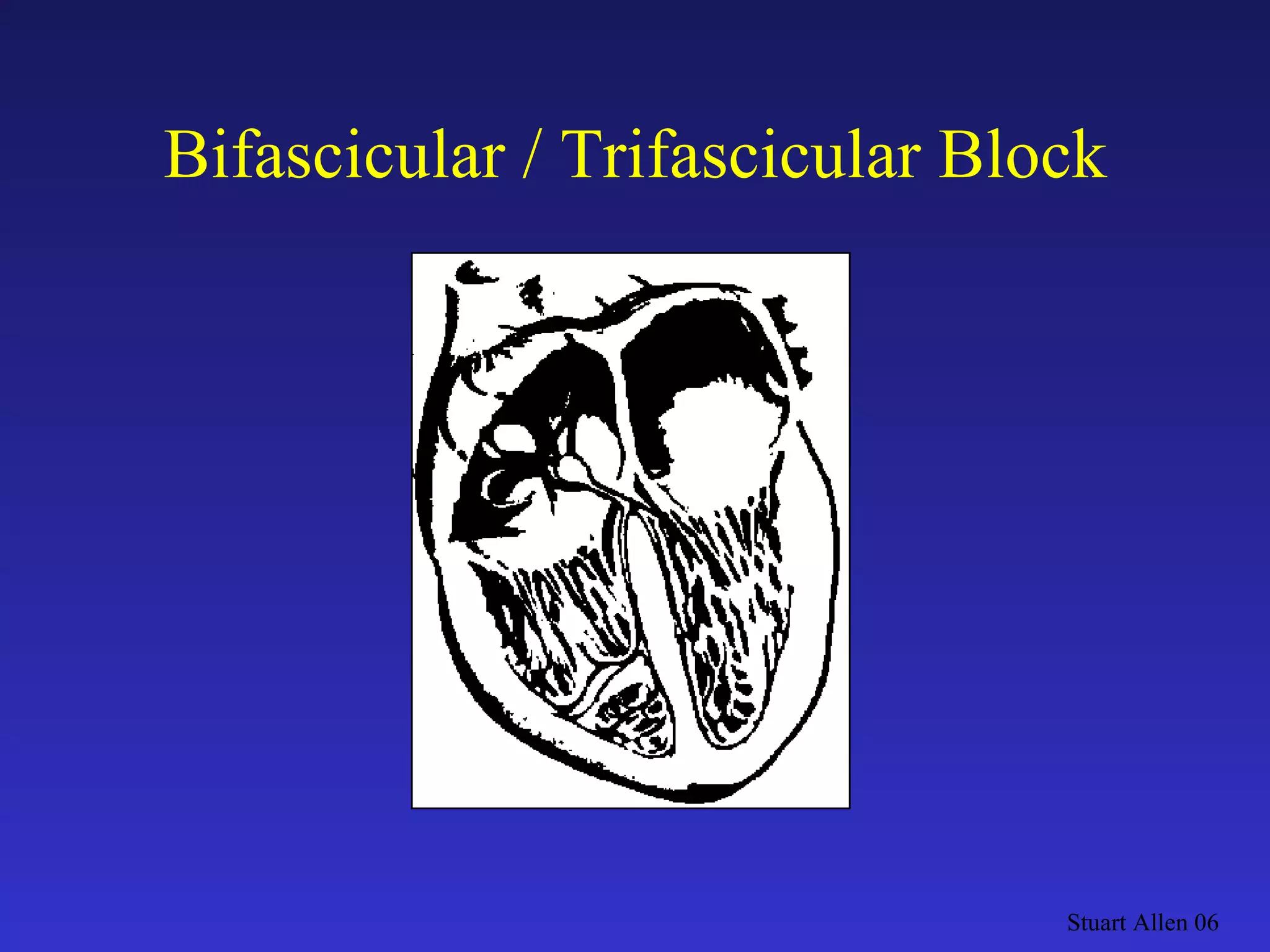 Bifascicular / Trifascicular Block Stuart Allen 06 