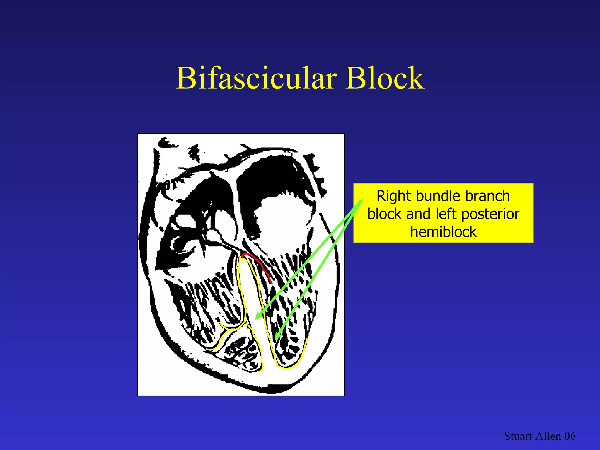 Bifascicular Block Stuart Allen 06 Right bundle branch block and left posterior hemiblock 