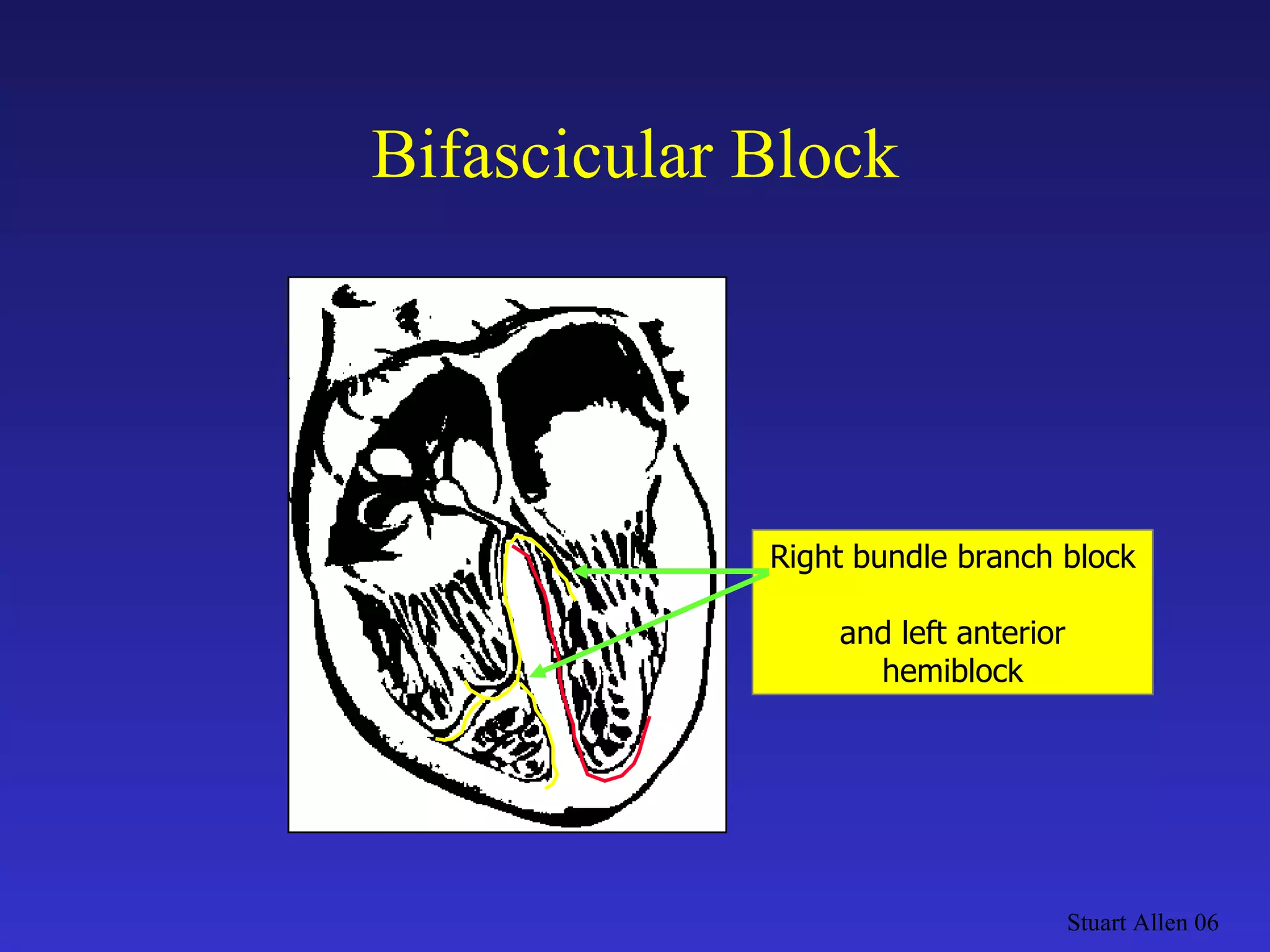 Bifascicular Block Stuart Allen 06 Right bundle branch block  and left anterior hemiblock 