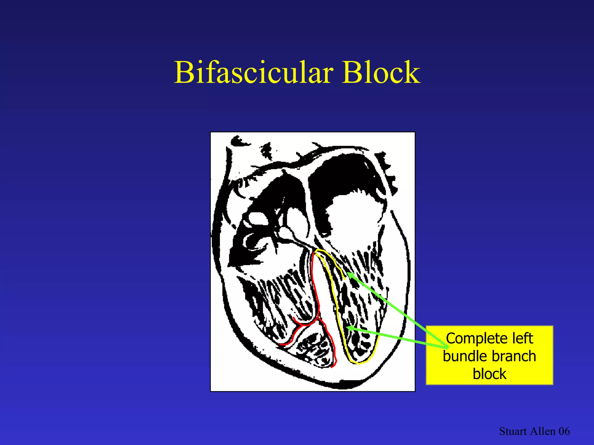 Bifascicular Block Stuart Allen 06 Complete left bundle branch block 