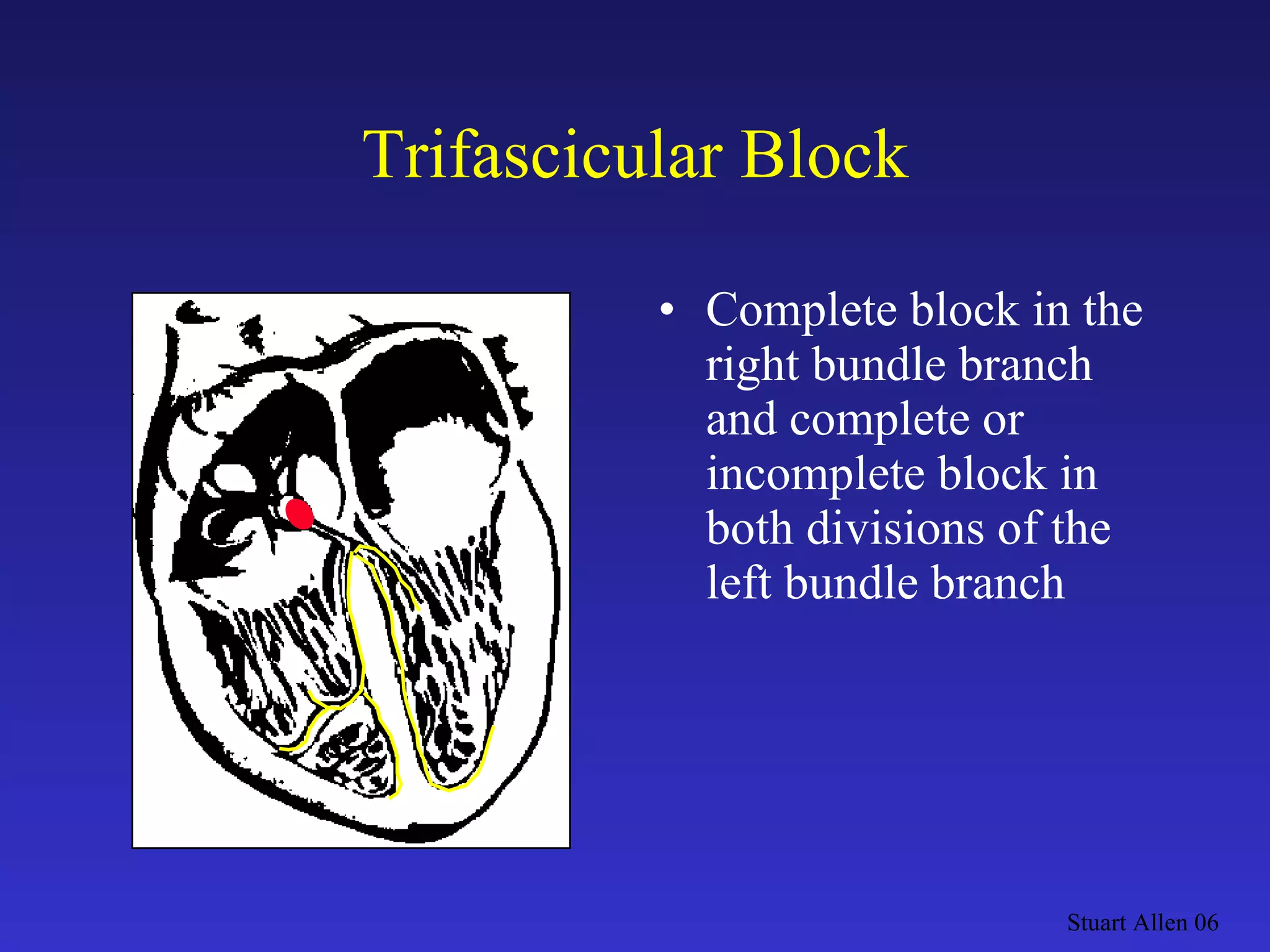 Trifascicular Block Complete block in the right bundle branch and complete or incomplete block in both divisions of the left bundle branch  Stuart Allen 06 