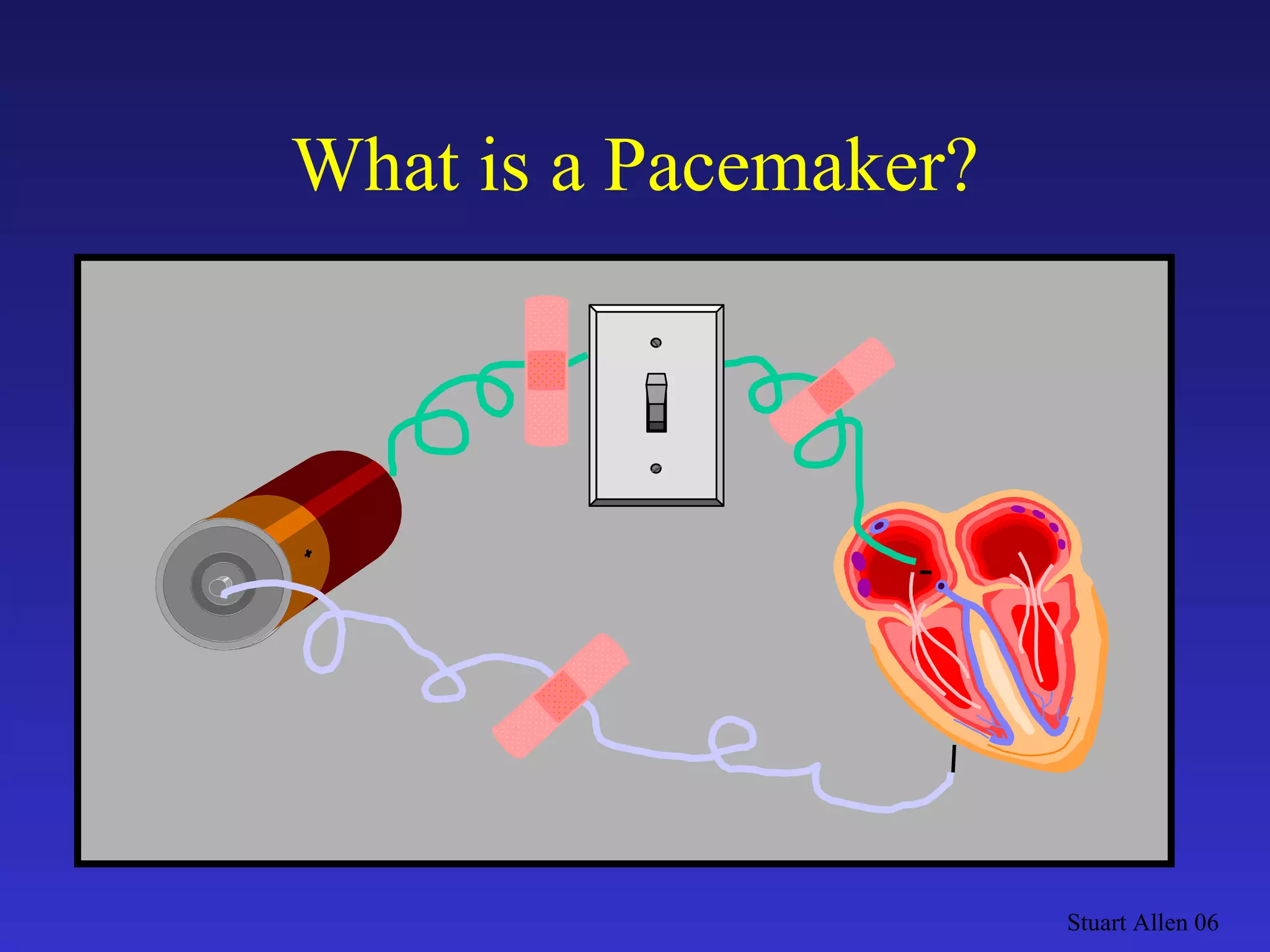 What is a Pacemaker? Stuart Allen 06 