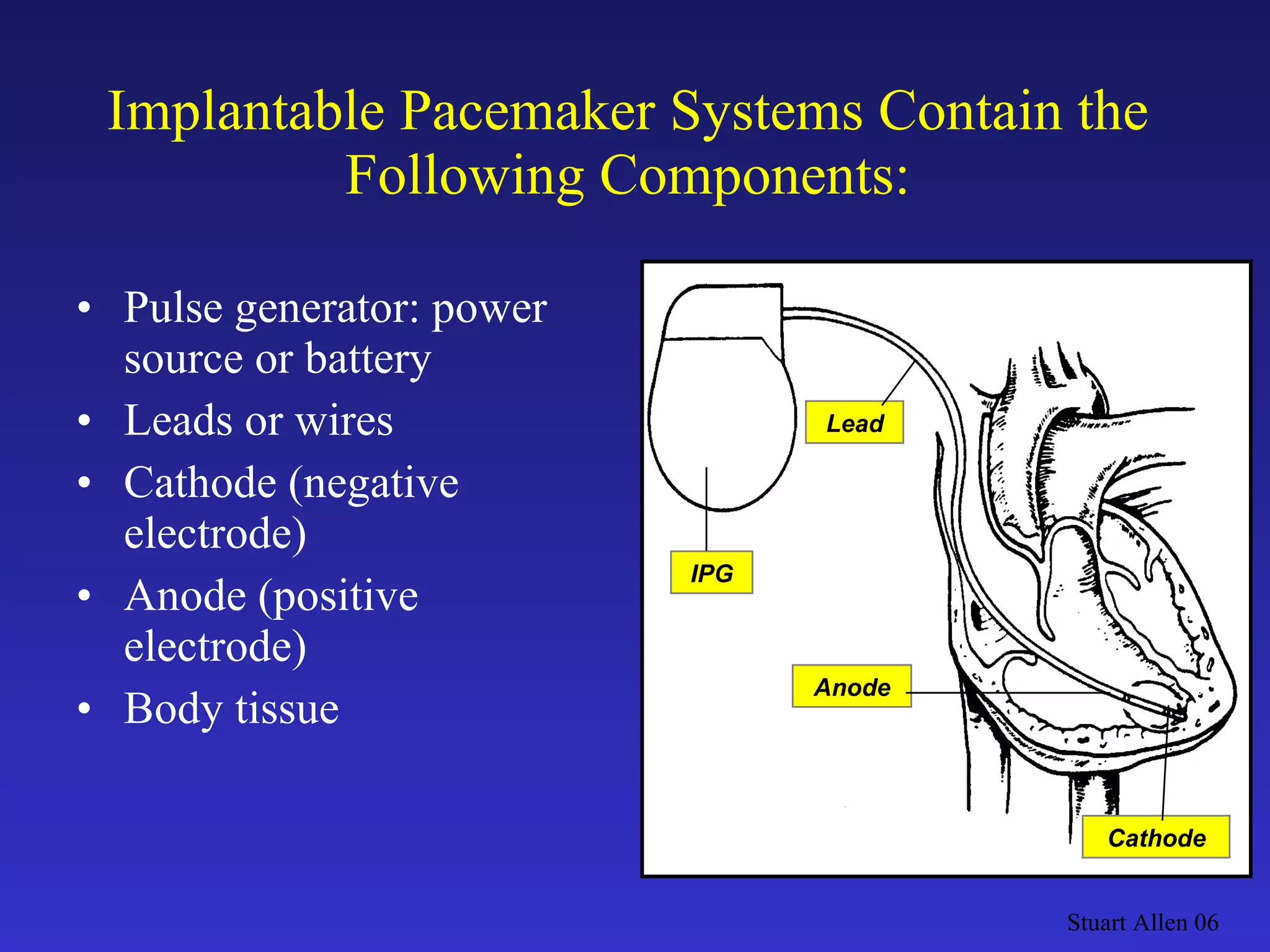 Pulse generator: power source or battery Leads or wires Cathode (negative electrode) Anode (positive electrode) Body tissue Implantable Pacemaker Systems Contain the Following Components: Stuart Allen 06 IPG Lead Anode Cathode 