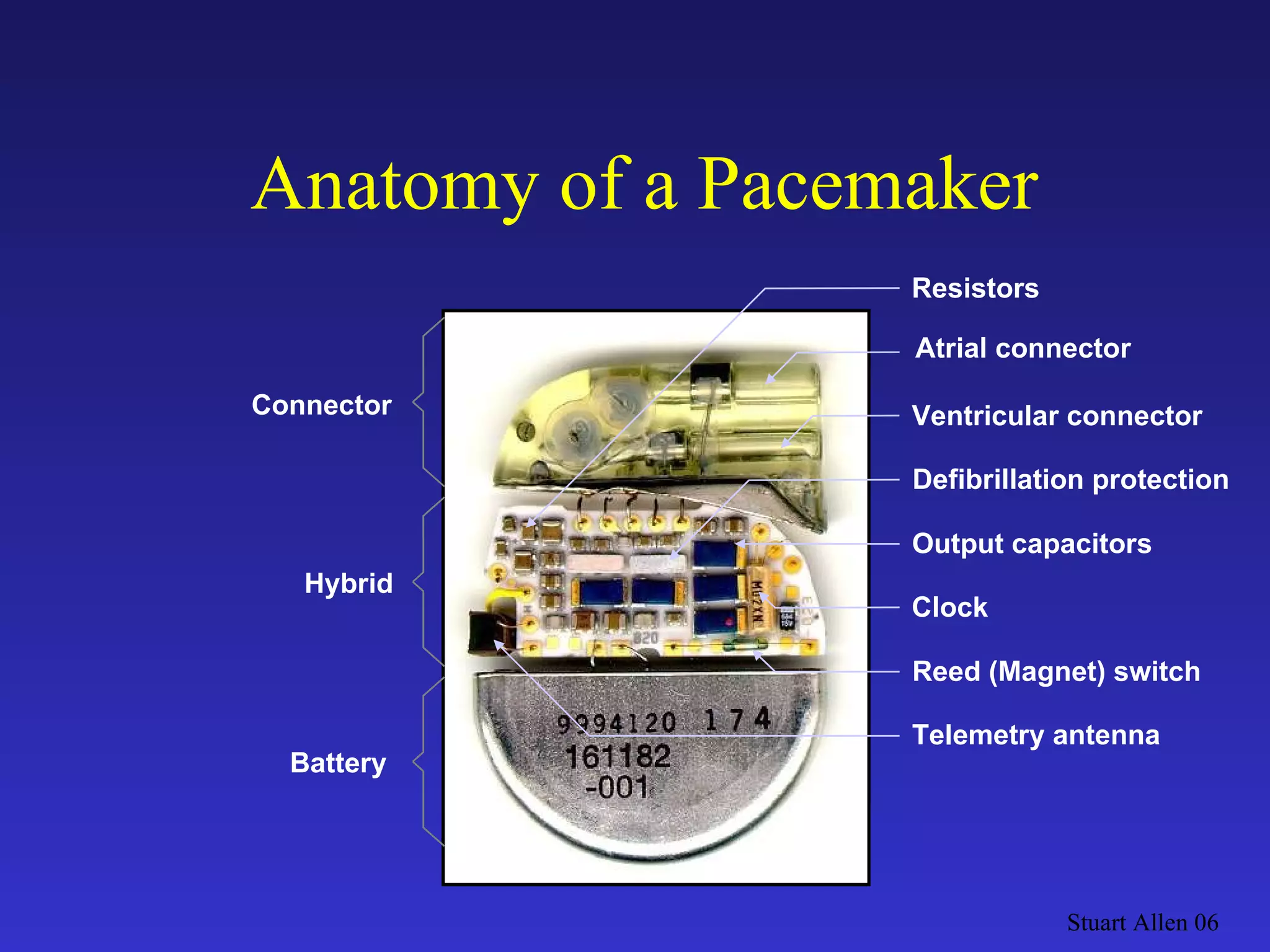 Stuart Allen 06 Battery Connector Hybrid Telemetry antenna Output capacitors Reed (Magnet) switch Clock Defibrillation protection Atrial connector Ventricular connector Resistors Anatomy of a Pacemaker 