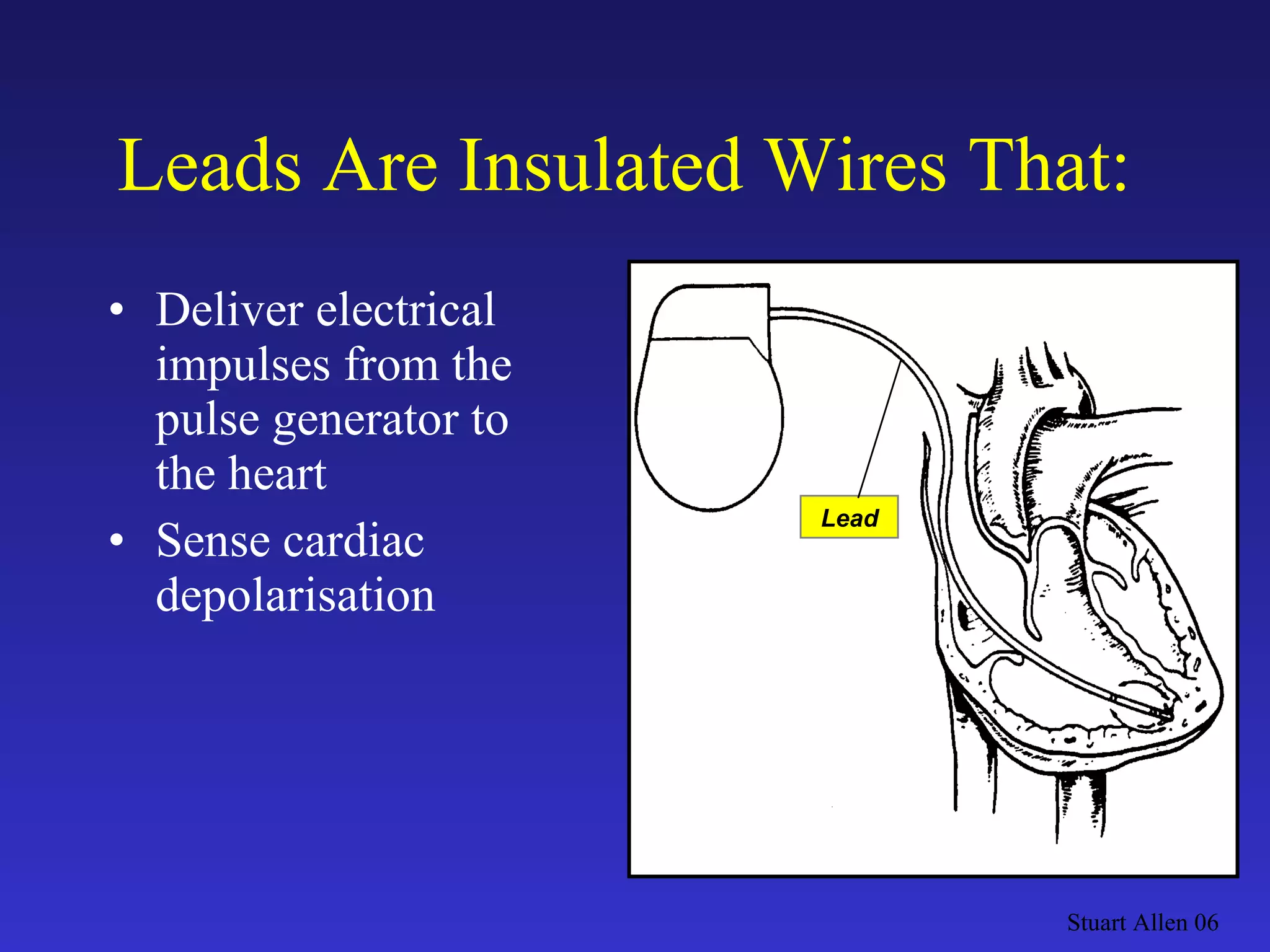 Deliver electrical impulses from the pulse generator to  the heart Sense cardiac depolarisation Leads Are Insulated Wires That: Stuart Allen 06 Lead 